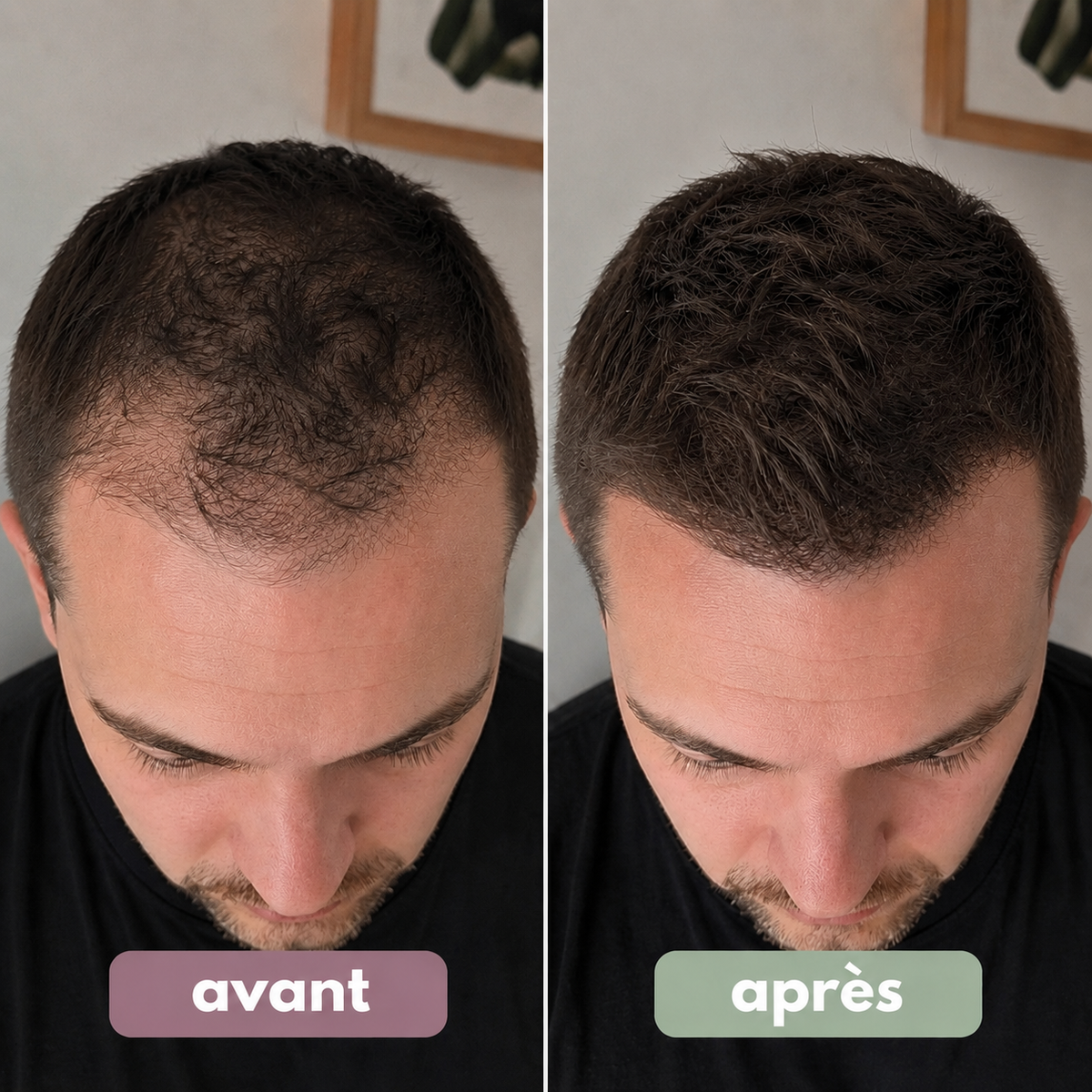 Sérum roll-on pour la pousse des cheveux